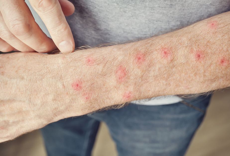 Мъжка ръка с червени обриви над китката.