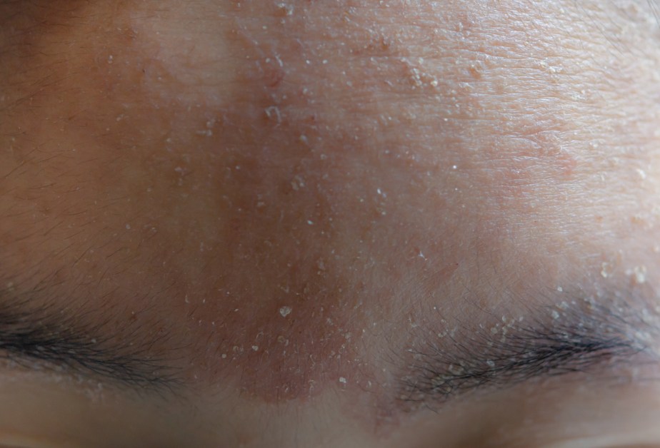 Челото на жена със симптоми на дерматит