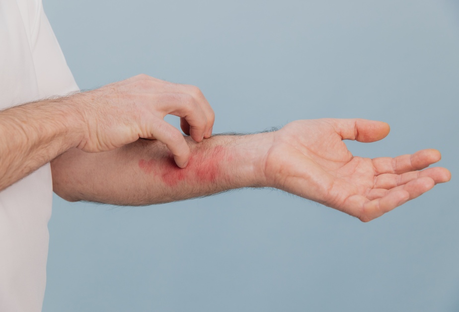 лекар чеше сърбящите му ръце