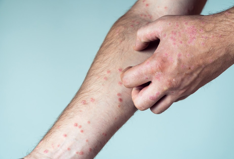 псориазис по ръцете