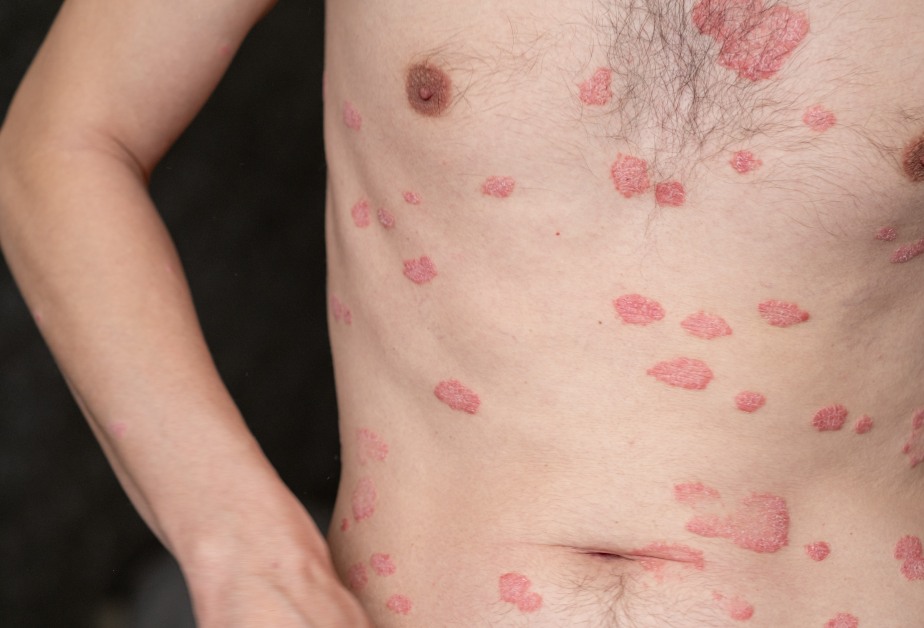 псориазис по тялото