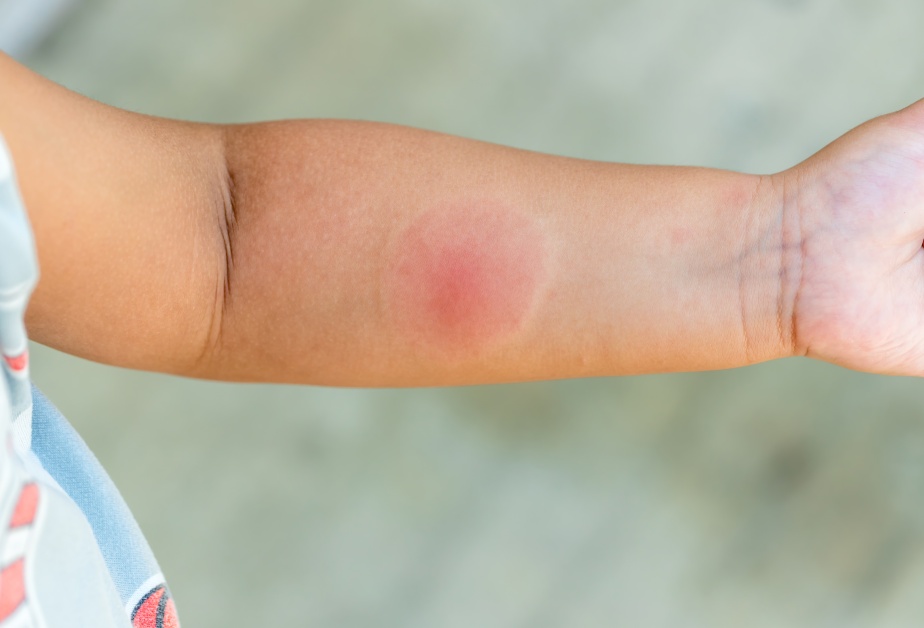 Подута ръка от ужилване от пчела