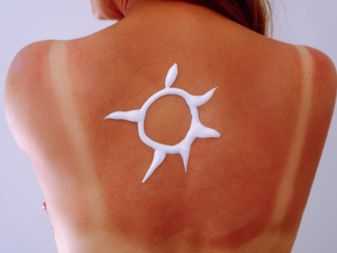 Слънчева алергия: Видове, симптоми и как да се предпазим