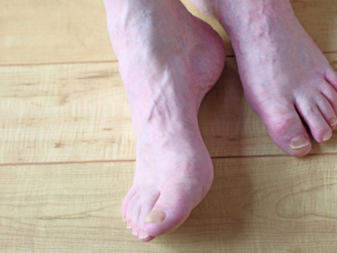 Посиняване на крайниците: Най-честите медицински причини
