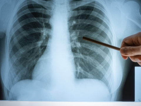 Бронхопневмония: Как се различава от класическата пневмония